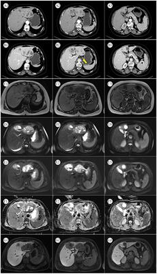 Surgical treatment of primary hepatic neuroendocrine tumor diagnosed by Al18F-NOTA-Octreotide PET/CT: a case report